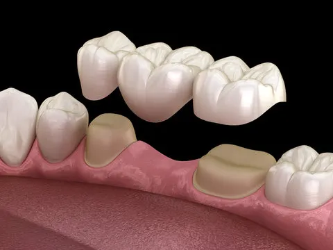 Dental crown and bridge restoration illustration